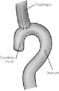 Robotic Gastrectomy Matches Laparoscopic Gastrectomy