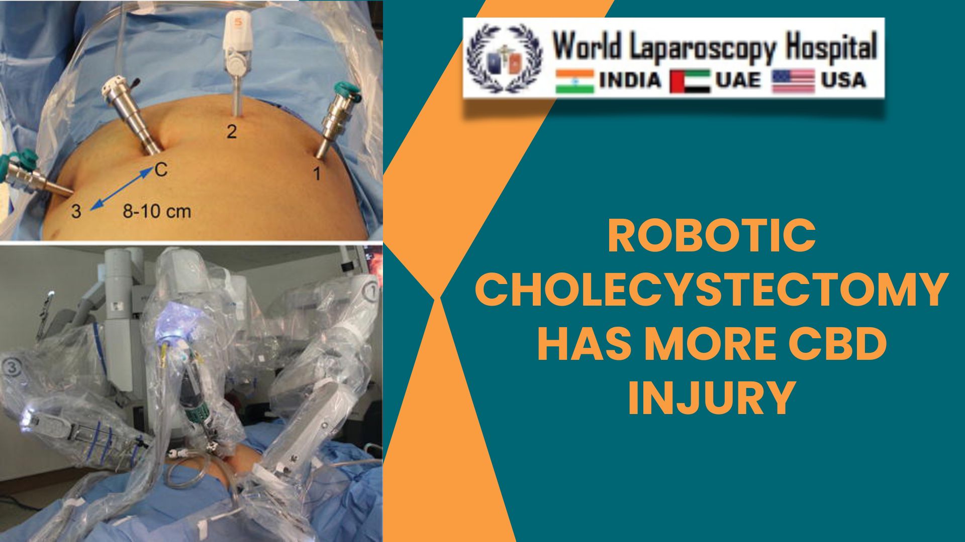 Robotic Cholecystectomy has more CBD Injury