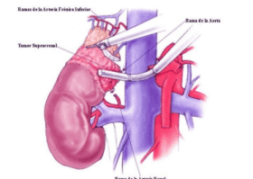 Impacto de la adrenalectomía laparoscópica en la supervivencia general en pacientes con carcinoma adrenocortical no metastásico.