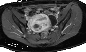 Manejo histeroscópico de la adenomiosis quística submucosa