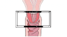 Mito sobre el muñón cervical después de una histerectomía supracervical