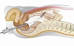 NOTAS ensayo en humanos sobre colecistectomías transorales y transvaginales.