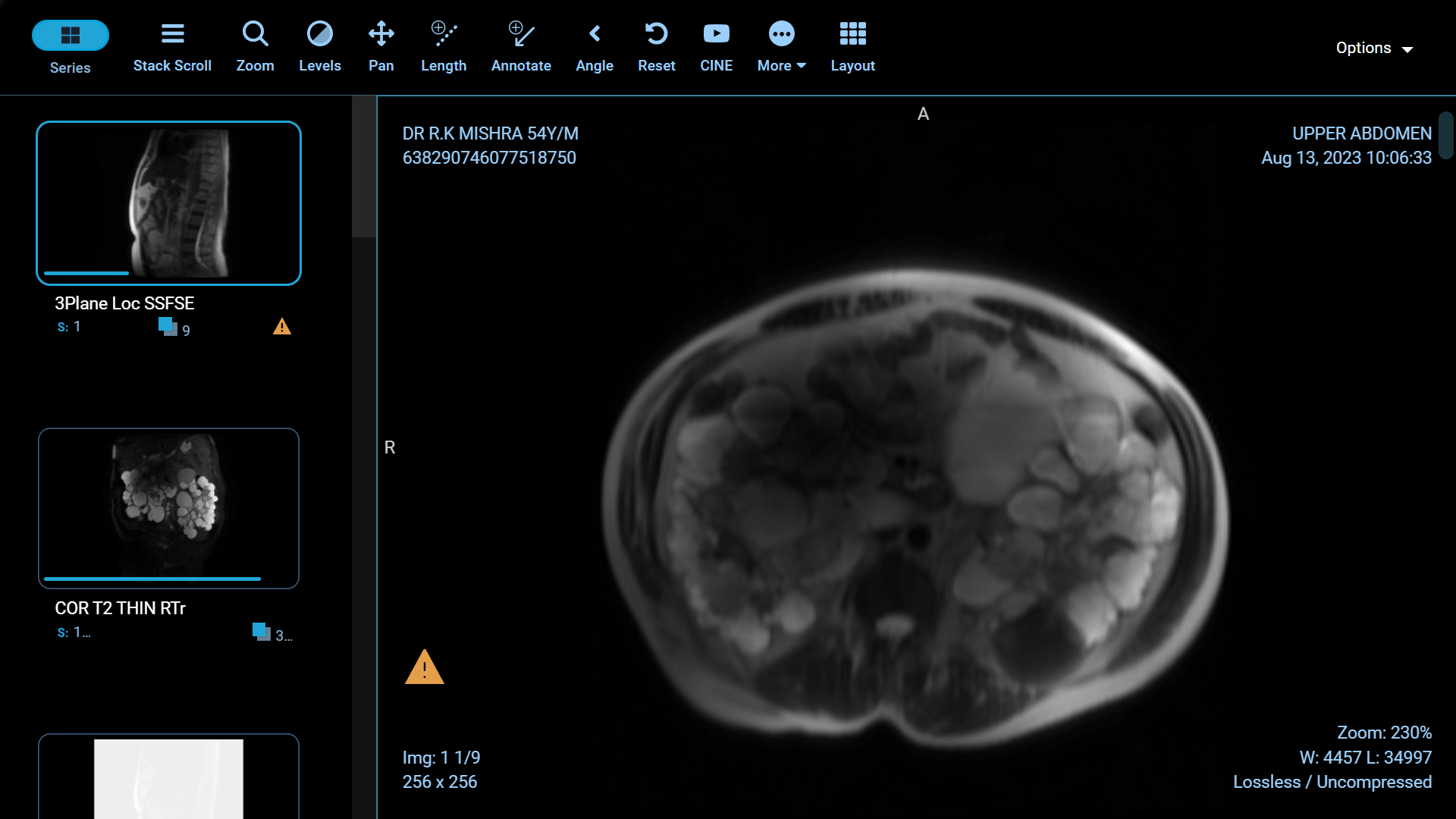 Adult Polycystic Kidney Disease