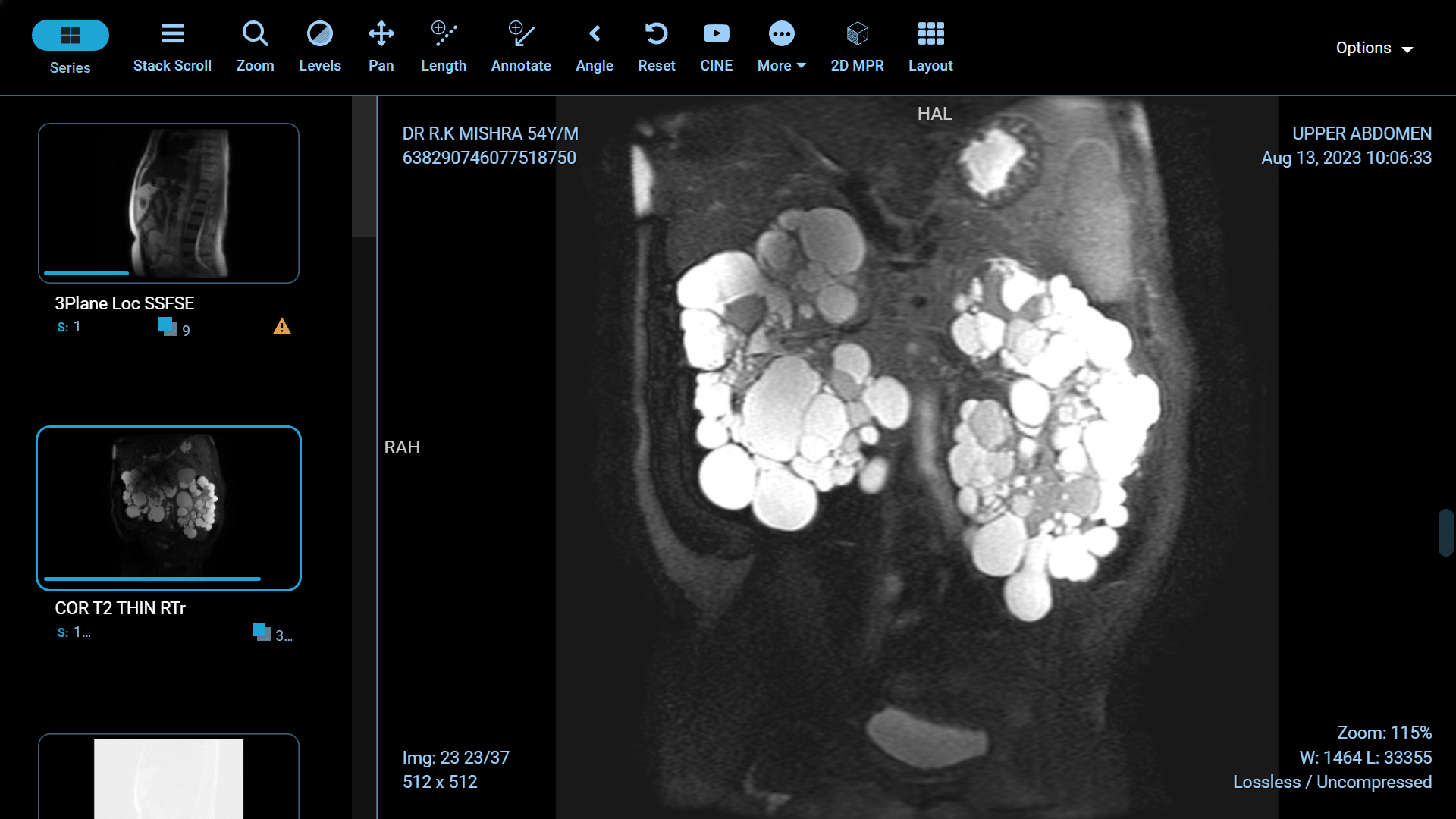 Adult Polycystic Kidney Disease