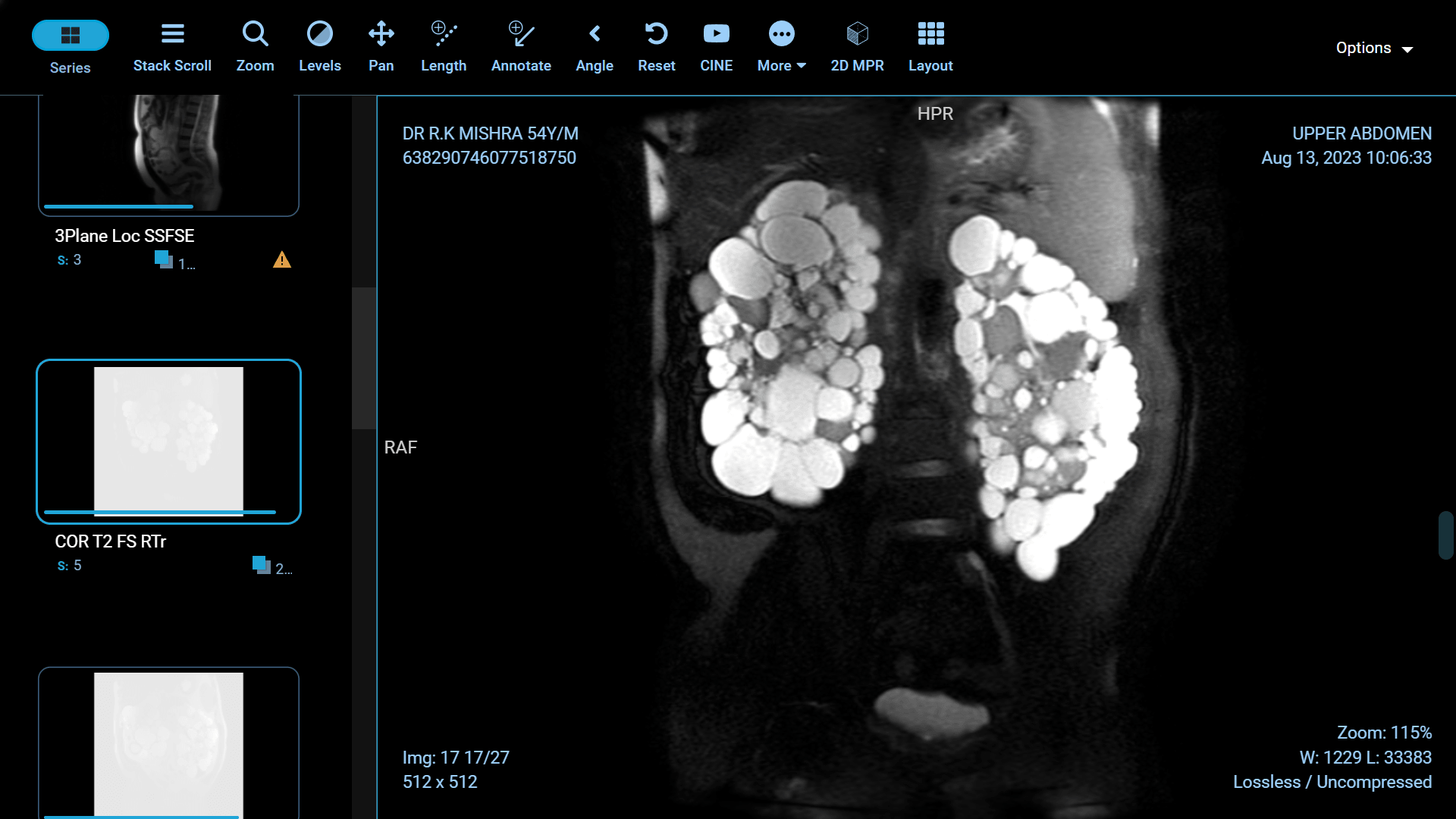 Adult Polycystic Kidney Disease