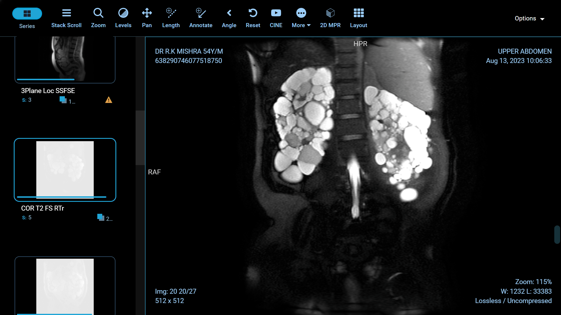 Adult Polycystic Kidney Disease