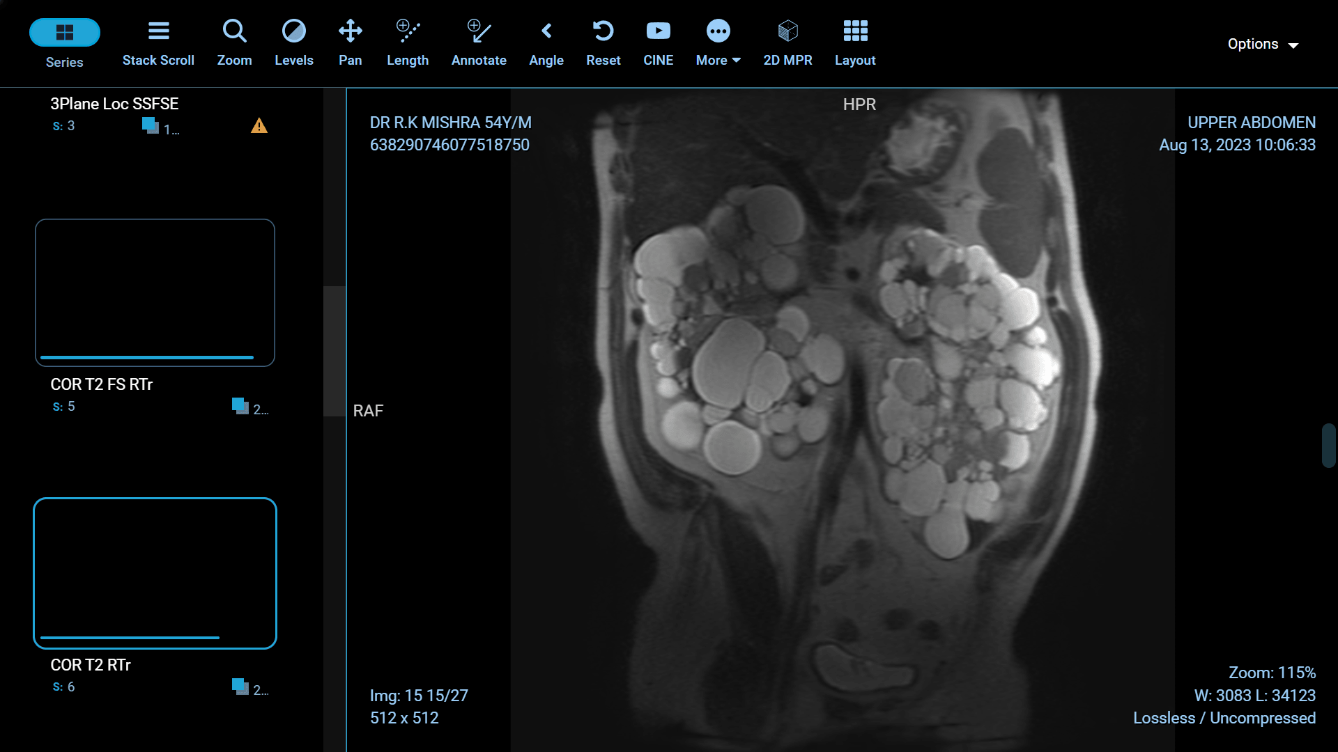 Adult Polycystic Kidney Disease