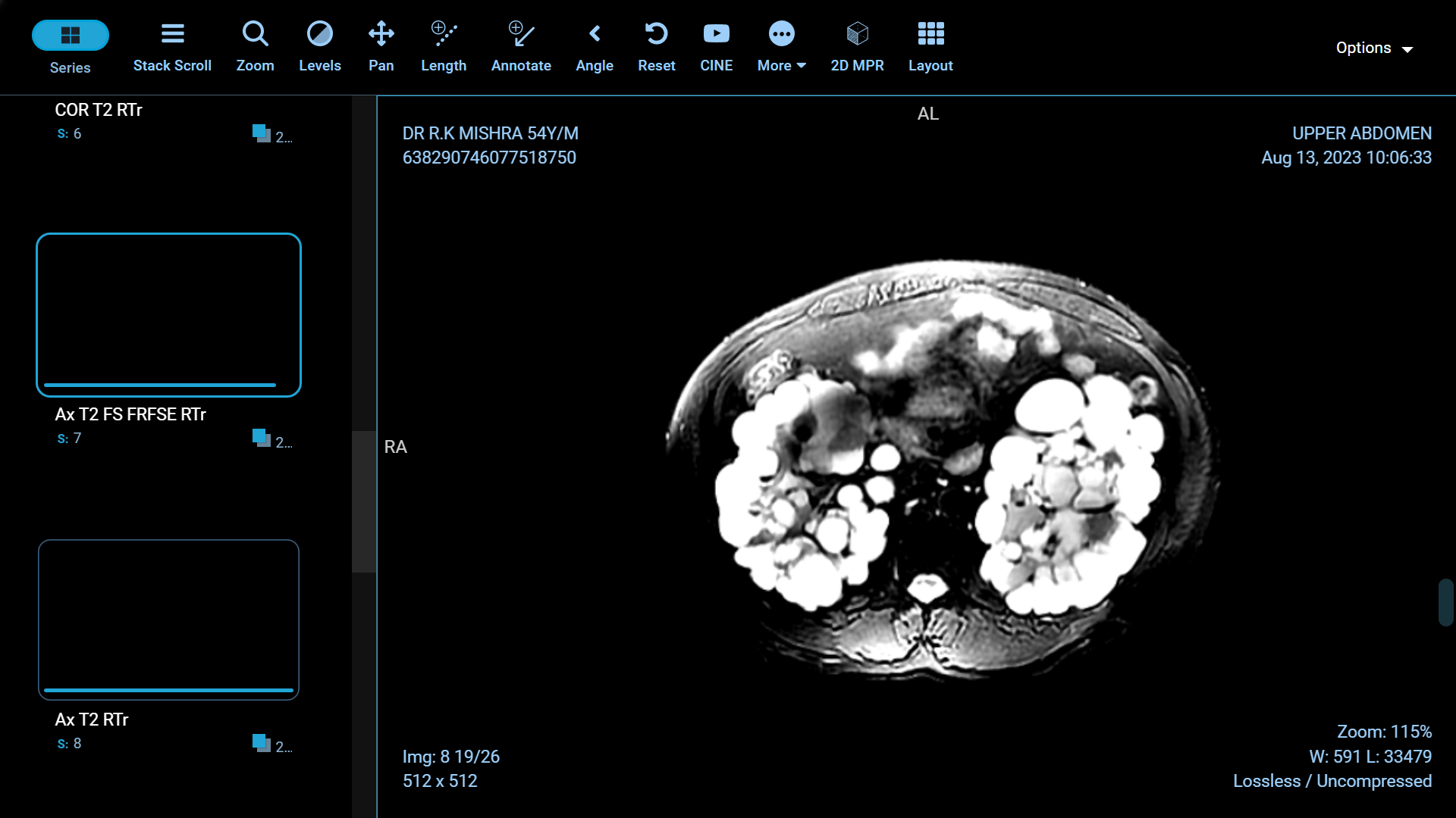 Adult Polycystic Kidney Disease