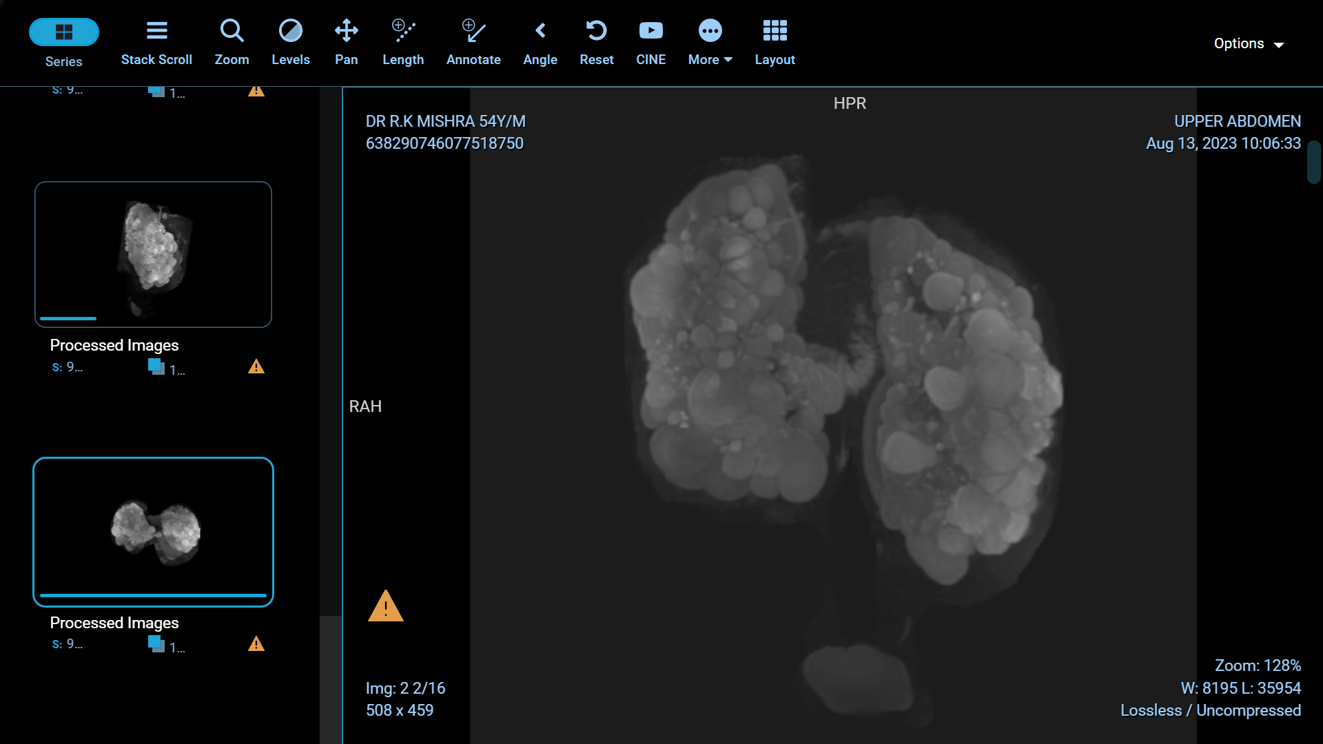 Adult Polycystic Kidney Disease