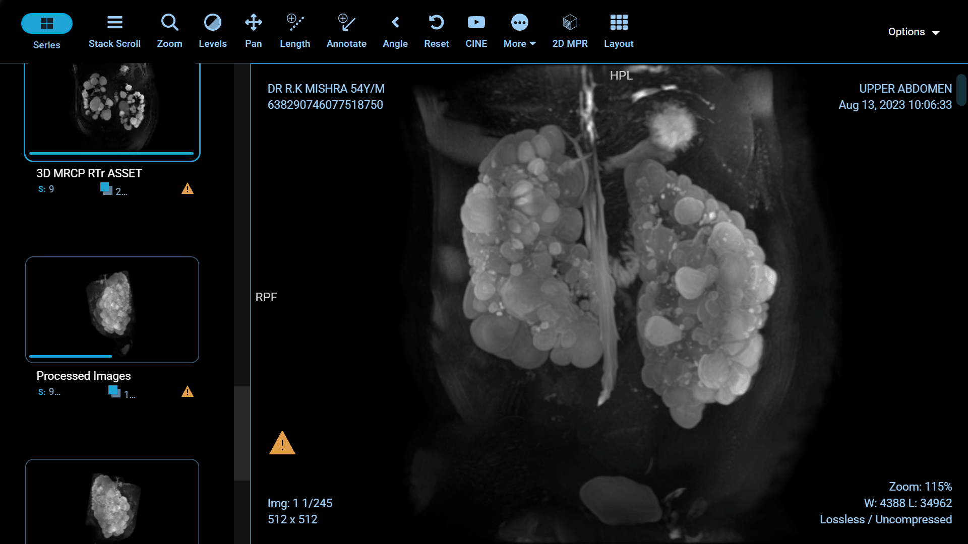 Adult Polycystic Kidney Disease