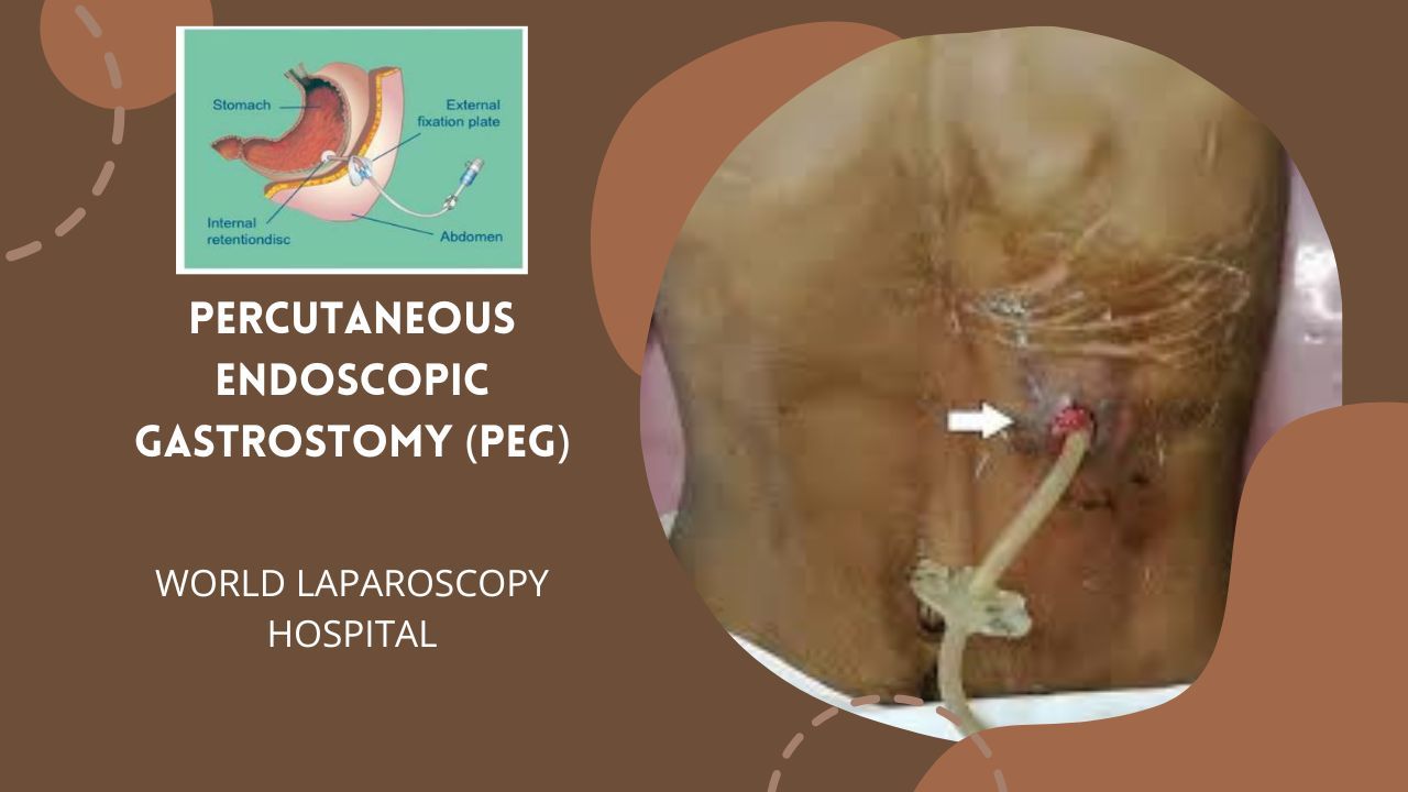 Percutaneous endoscopic gastrostomy (PEG)