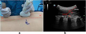 Erector spinae plane block in laparoscopic colorectal surgery